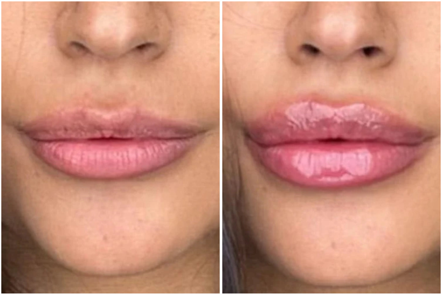 Plump Lips Extreme